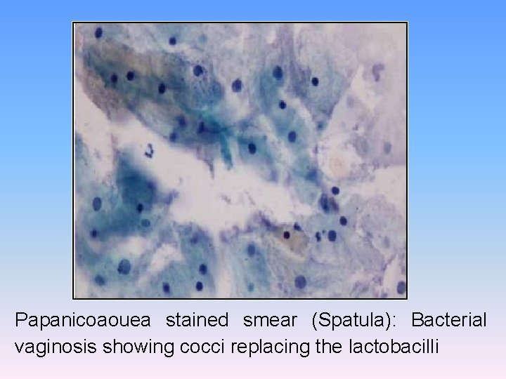 Papanicoaouea stained smear (Spatula): Bacterial vaginosis showing cocci replacing the lactobacilli 