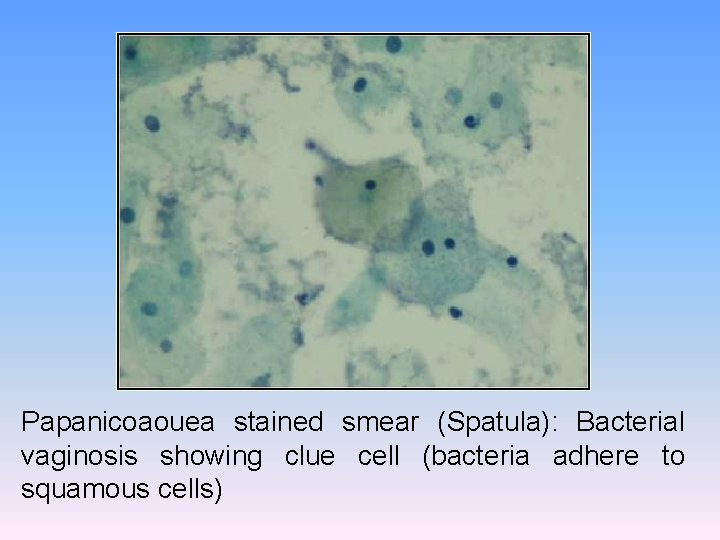 Papanicoaouea stained smear (Spatula): Bacterial vaginosis showing clue cell (bacteria adhere to squamous cells)