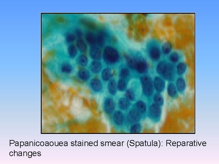 Papanicoaouea stained smear (Spatula): Reparative changes 