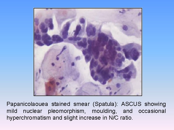 Papanicolaouea stained smear (Spatula): ASCUS showing mild nuclear pleomorphism, moulding, and occasional hyperchromatism and
