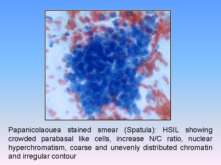 Papanicolaouea stained smear (Spatula): HSIL showing crowded parabasal like cells, increase N/C ratio, nuclear