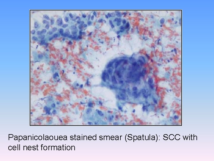 Papanicolaouea stained smear (Spatula): SCC with cell nest formation 