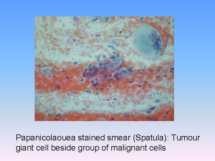 Papanicolaouea stained smear (Spatula): Tumour giant cell beside group of malignant cells 
