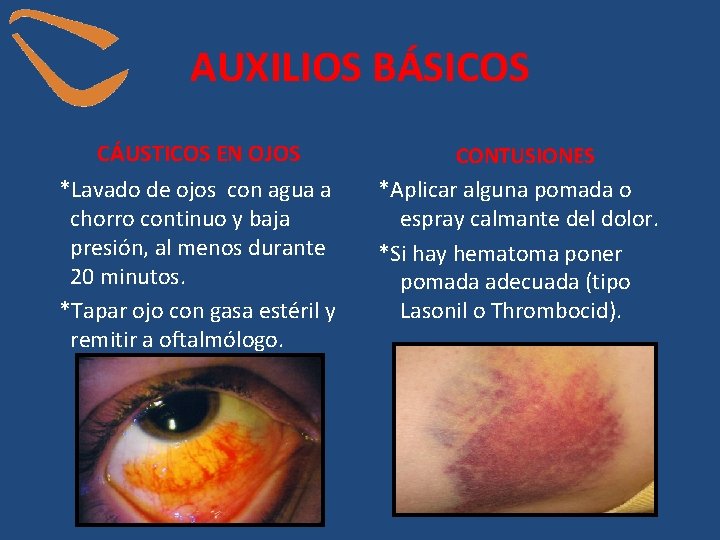 AUXILIOS BÁSICOS CÁUSTICOS EN OJOS *Lavado de ojos con agua a chorro continuo y