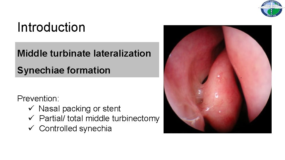 Introduction Middle turbinate lateralization Synechiae formation Prevention: ü Nasal packing or stent ü Partial/