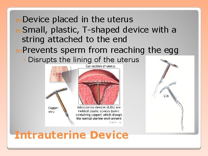  Device placed in the uterus Small, plastic, T-shaped device with a string attached