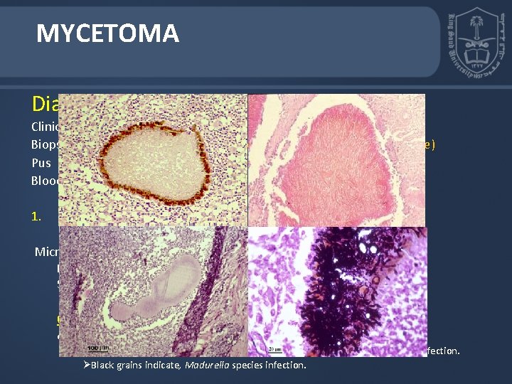 MYCETOMA Diagnosis: Clinical samples: Biopsy tissue (Superficial samples of the draining sinuses are inadequate)