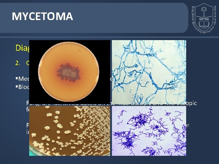 MYCETOMA Diagnosis 2. Culture §Media such as Sabouraud dextrose agar (SDA) to isolate fungi