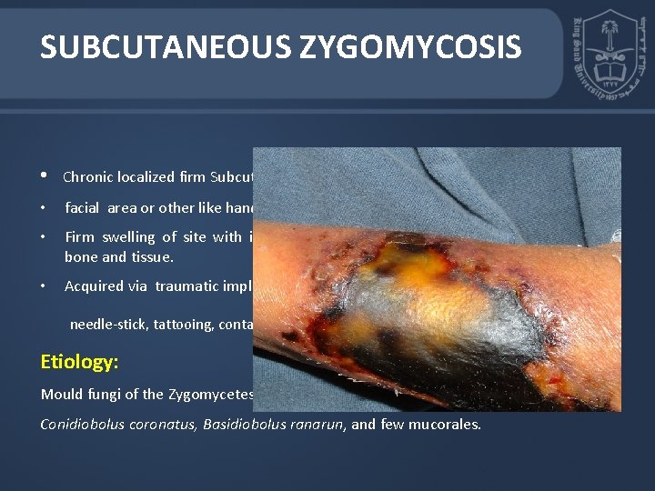 SUBCUTANEOUS ZYGOMYCOSIS • Chronic localized firm Subcutaneous masses • facial area or other like