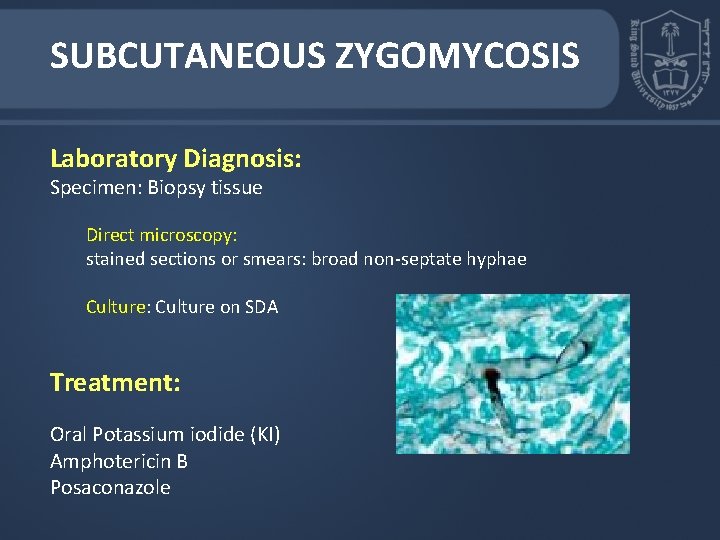 SUBCUTANEOUS ZYGOMYCOSIS Laboratory Diagnosis: Specimen: Biopsy tissue Direct microscopy: stained sections or smears: broad