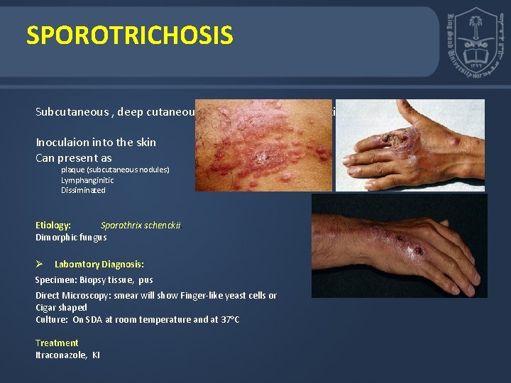 SPOROTRICHOSIS Subcutaneous , deep cutaneous or systemic fungal infection Inoculaion into the skin Can