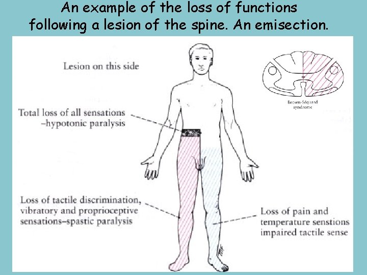 An example of the loss of functions following a lesion of the spine. An