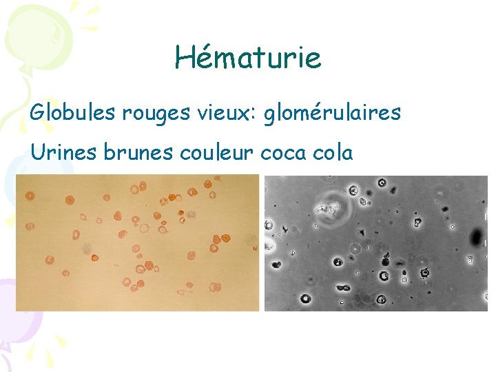 Hématurie Globules rouges vieux: glomérulaires Urines brunes couleur coca cola 