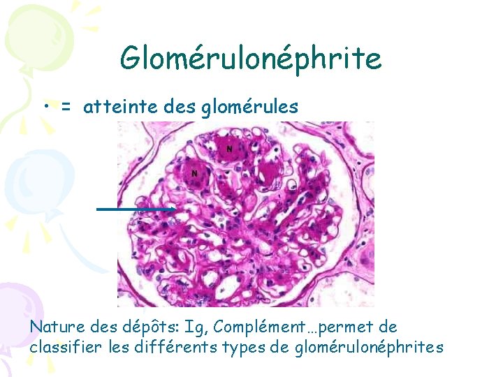 Glomérulonéphrite • = atteinte des glomérules Nature des dépôts: Ig, Complément…permet de classifier les