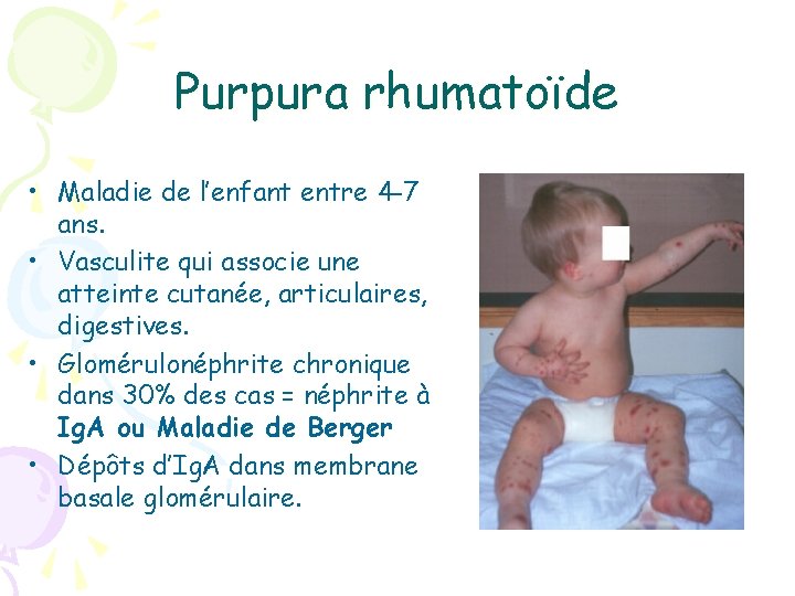 Purpura rhumatoïde • Maladie de l’enfant entre 4 -7 ans. • Vasculite qui associe