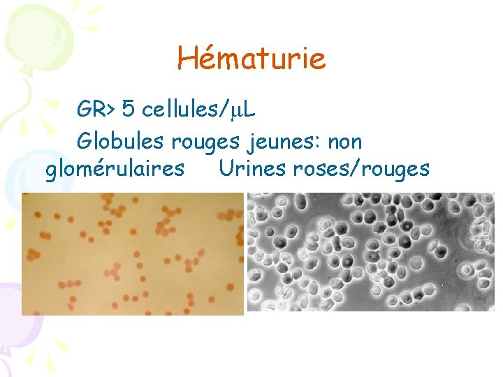 Hématurie GR> 5 cellules/ L Globules rouges jeunes: non glomérulaires Urines roses/rouges 