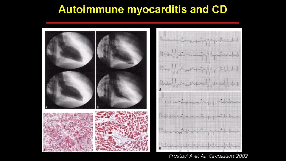 Autoimmune myocarditis and CD Frustaci A et Al. Circulation 2002 