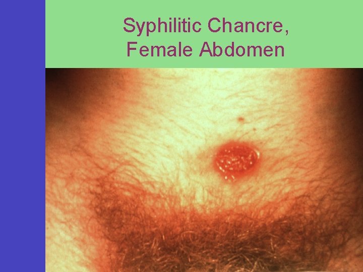 Syphilitic Chancre, Female Abdomen 