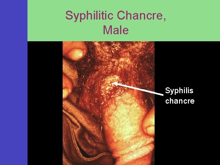 Syphilitic Chancre, Male Syphilis chancre 