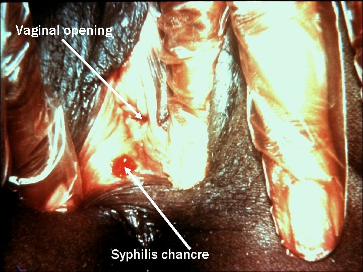 Vaginal opening Syphilis chancre 