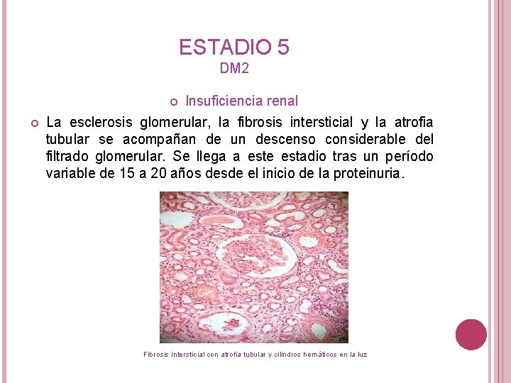 ESTADIO 5 DM 2 Insuficiencia renal La esclerosis glomerular, la fibrosis intersticial y la