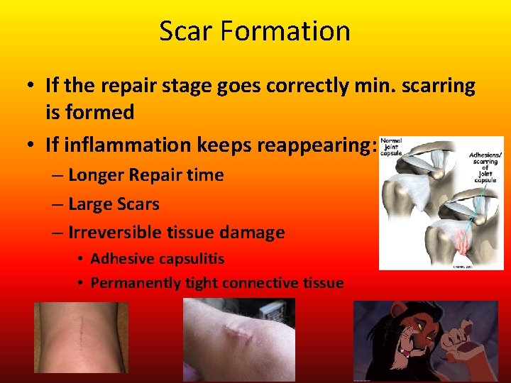 Scar Formation • If the repair stage goes correctly min. scarring is formed •