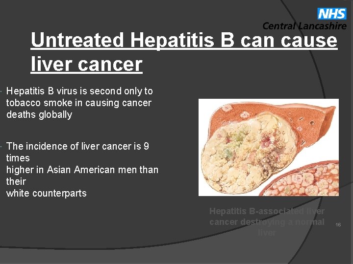 Untreated Hepatitis B can cause liver cancer Hepatitis B virus is second only to