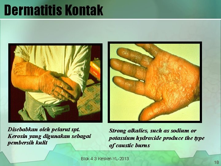Dermatitis Kontak Disebabkan oleh pelarut spt. Kerosin yang digunakan sebagai pembersih kulit Strong alkalies,