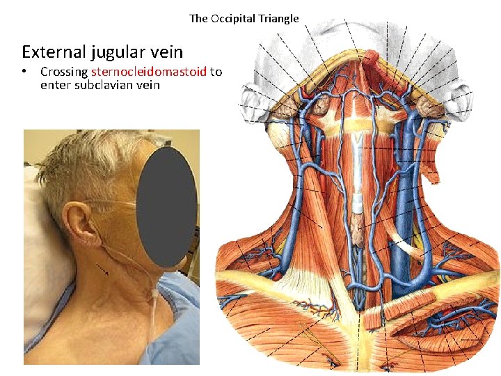 The Occipital Triangle External jugular vein • Crossing sternocleidomastoid to enter subclavian vein 
