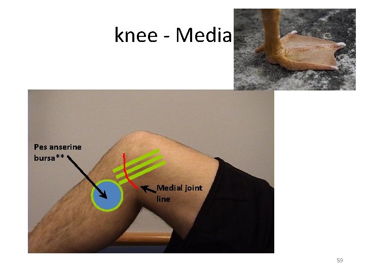 knee - Medial Pes anserine bursa** Medial joint line 59 