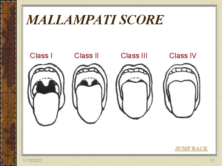 MALLAMPATI SCORE Class III Class IV JUMP BACK 1/17/2022 12 