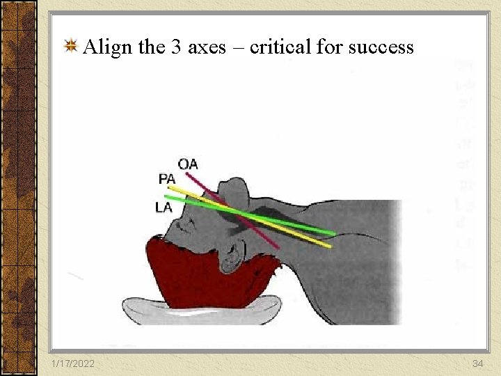 Align the 3 axes – critical for success Sellick’s maneuver 1/17/2022 34 