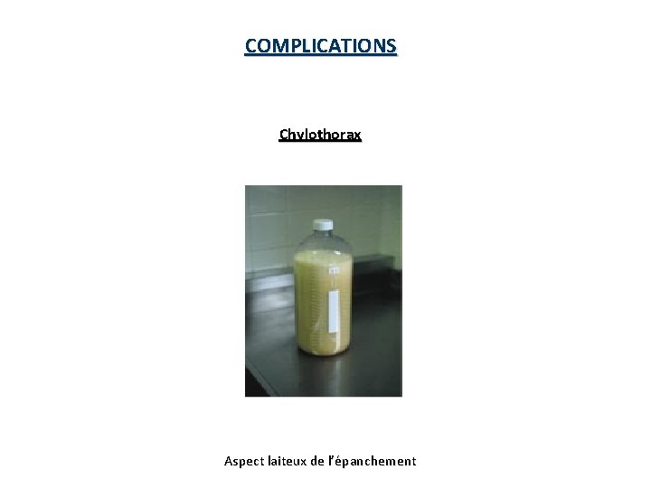 COMPLICATIONS Chylothorax Aspect laiteux de l’épanchement COMPLICATIONS Chylothorax Aspect laiteux de l’épanchement