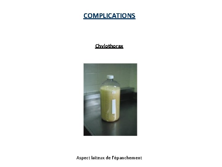 COMPLICATIONS Chylothorax Aspect laiteux de l’épanchement 