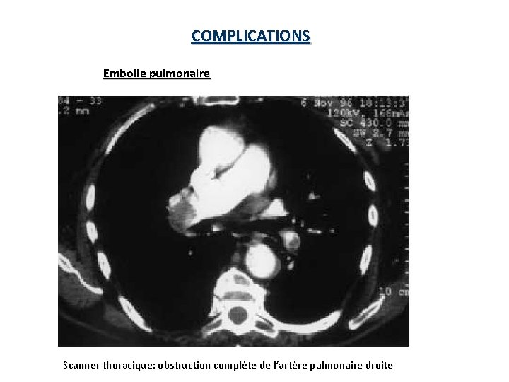 COMPLICATIONS Embolie pulmonaire Scanner thoracique: obstruction complète de l’artère pulmonaire droite 