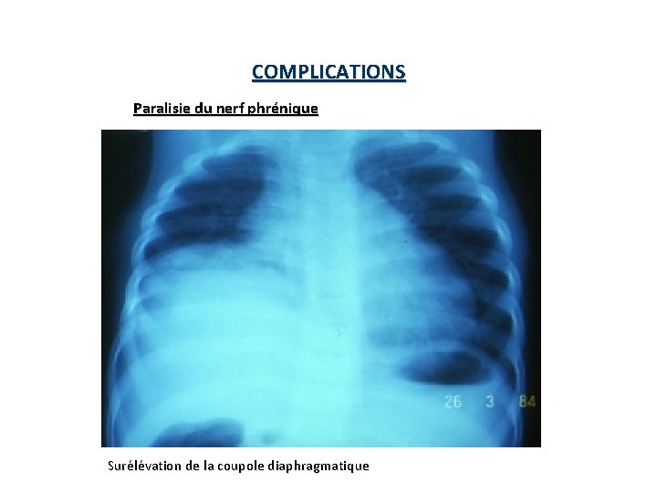 COMPLICATIONS Paralisie du nerf phrénique Surélévation de la coupole diaphragmatique COMPLICATIONS Paralisie du nerf phrénique Surélévation de la coupole diaphragmatique