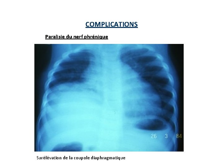 COMPLICATIONS Paralisie du nerf phrénique Surélévation de la coupole diaphragmatique 