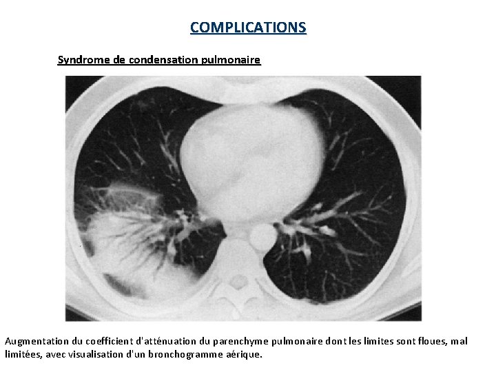 COMPLICATIONS Syndrome de condensation pulmonaire Augmentation du coefficient d'atténuation du parenchyme pulmonaire dont les COMPLICATIONS Syndrome de condensation pulmonaire Augmentation du coefficient d'atténuation du parenchyme pulmonaire dont les