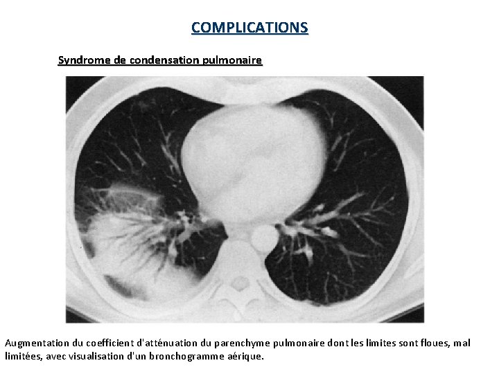 COMPLICATIONS Syndrome de condensation pulmonaire Augmentation du coefficient d'atténuation du parenchyme pulmonaire dont les