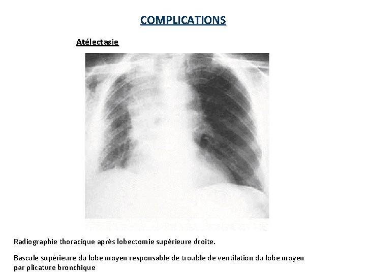 COMPLICATIONS Atélectasie Radiographie thoracique après lobectomie supérieure droite. Bascule supérieure du lobe moyen responsable COMPLICATIONS Atélectasie Radiographie thoracique après lobectomie supérieure droite. Bascule supérieure du lobe moyen responsable