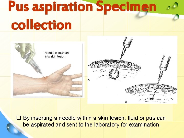 Pus aspiration Specimen collection q By inserting a needle within a skin lesion, fluid