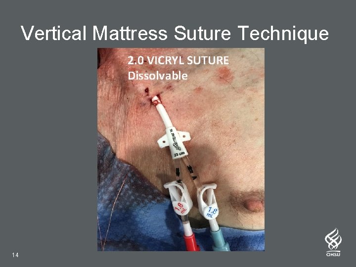 Vertical Mattress Suture Technique 2. 0 VICRYL SUTURE Dissolvable 14 