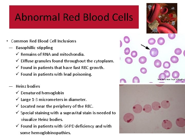 Abnormal Red Blood Cells • Common Red Blood Cell Inclusions — Basophillic stippling ü Abnormal Red Blood Cells • Common Red Blood Cell Inclusions — Basophillic stippling ü