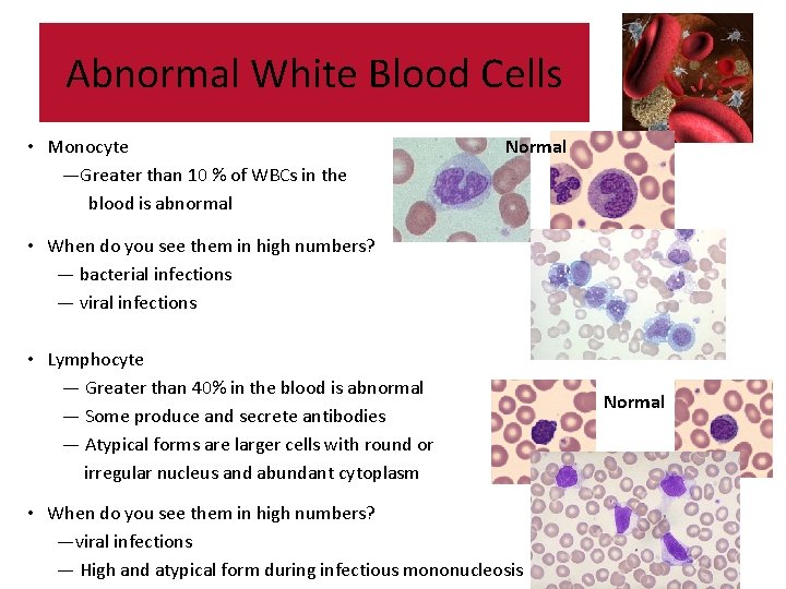 Abnormal White Blood Cells • Monocyte —Greater than 10 % of WBCs in the Abnormal White Blood Cells • Monocyte —Greater than 10 % of WBCs in the
