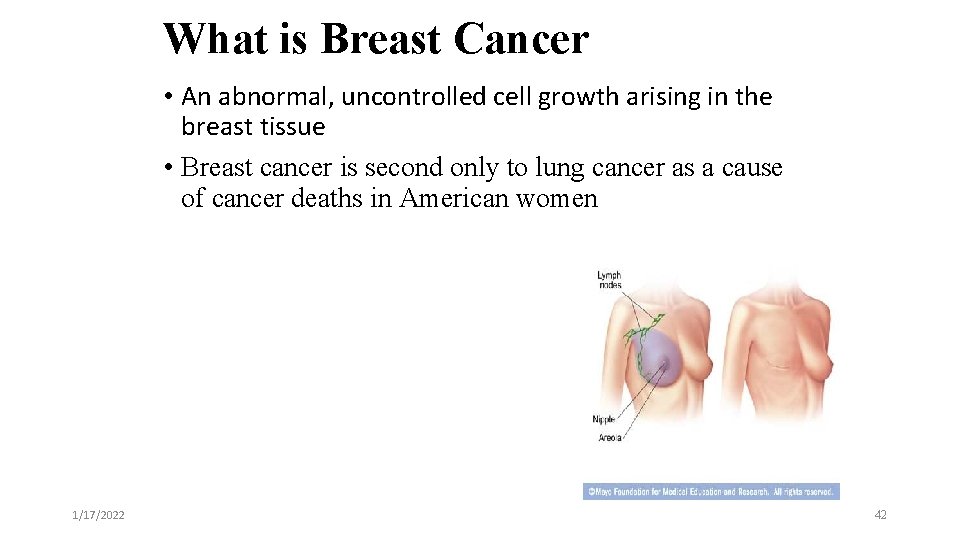 What is Breast Cancer • An abnormal, uncontrolled cell growth arising in the breast