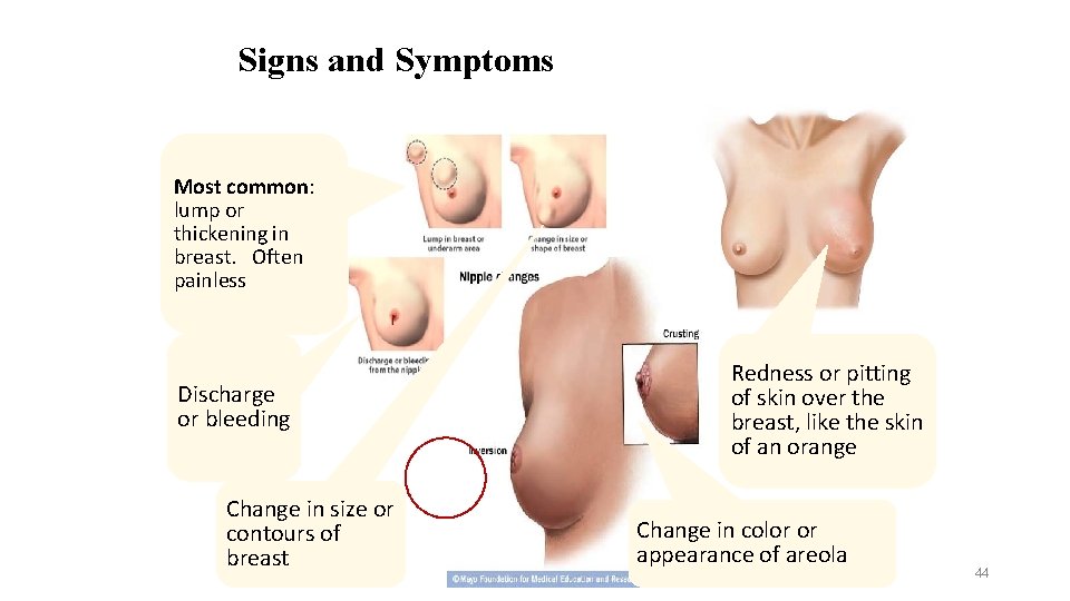 Signs and Symptoms Most common: lump or thickening in breast. Often painless Discharge or