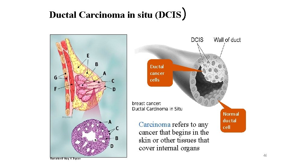 Ductal Carcinoma in situ (DCIS) Ductal cancer cells Carcinoma refers to any cancer that