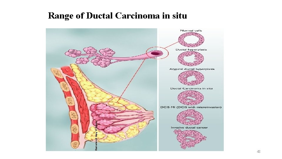 Illustration © Mary K. Bryson Range of Ductal Carcinoma in situ 48 