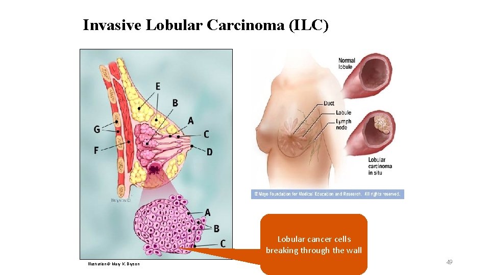 Invasive Lobular Carcinoma (ILC) Lobular cancer cells breaking through the wall Illustration © Mary