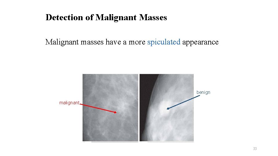 Detection of Malignant Masses Malignant masses have a more spiculated appearance benign malignant 55